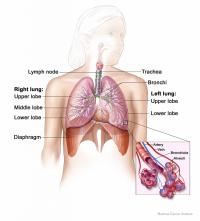 سرطان الرئة لغير المدخنين