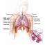 Lung Cancer in Non-Smokers